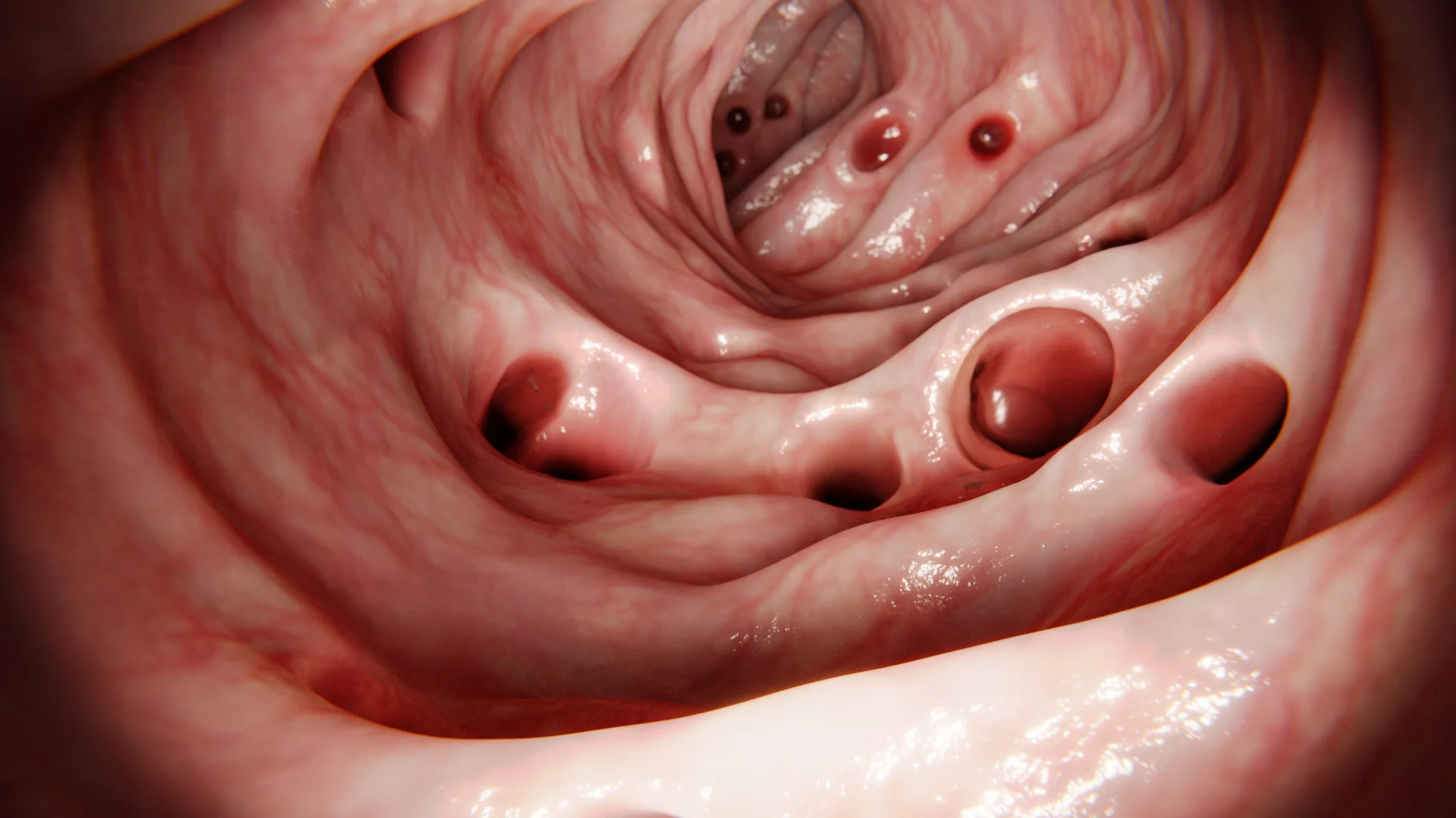 Diverticula of the Digestive Tract